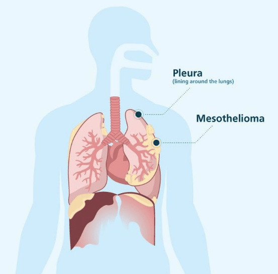 Infographic explaining mesothelioma in the lungs