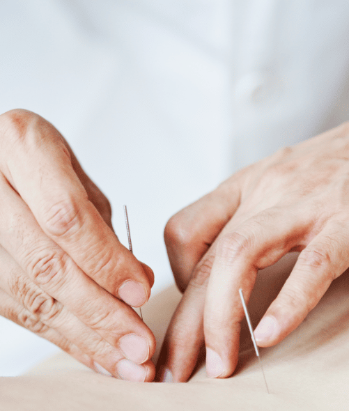 Person applying acupuncture